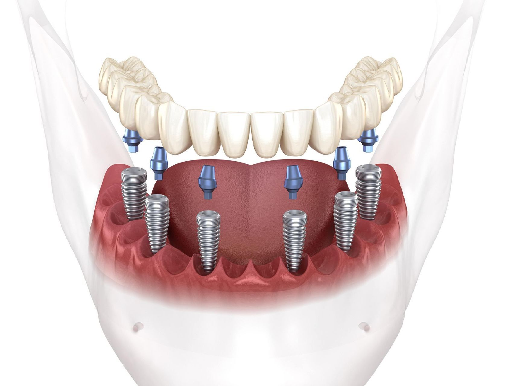 A computer generated image of all-on-6 implants and a full arch tooth replacement