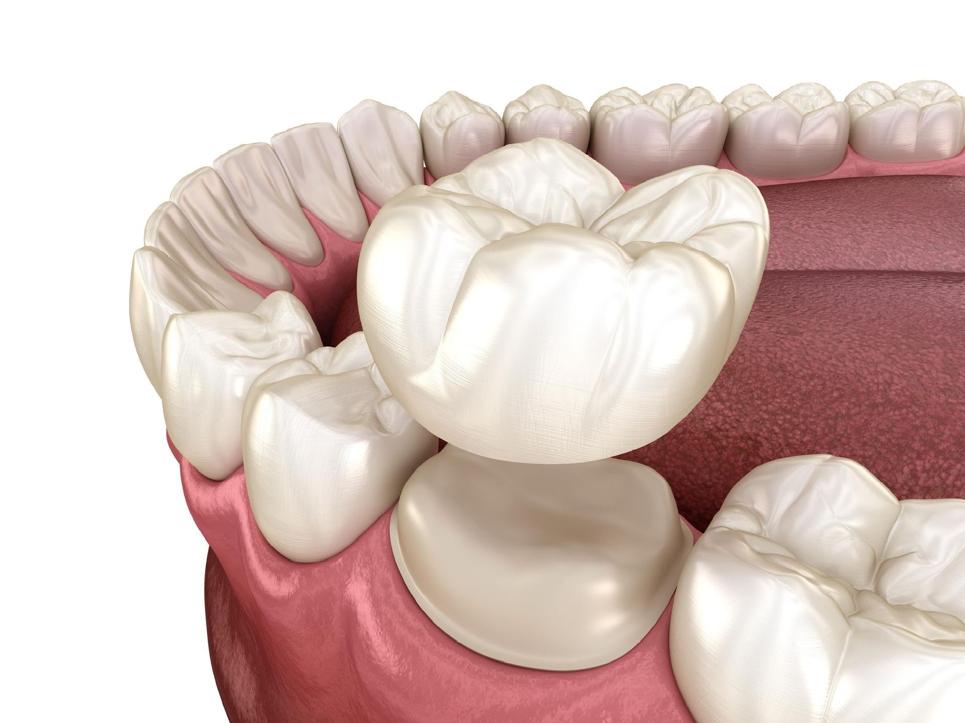 A computer generated image of a dental crown above a tooth