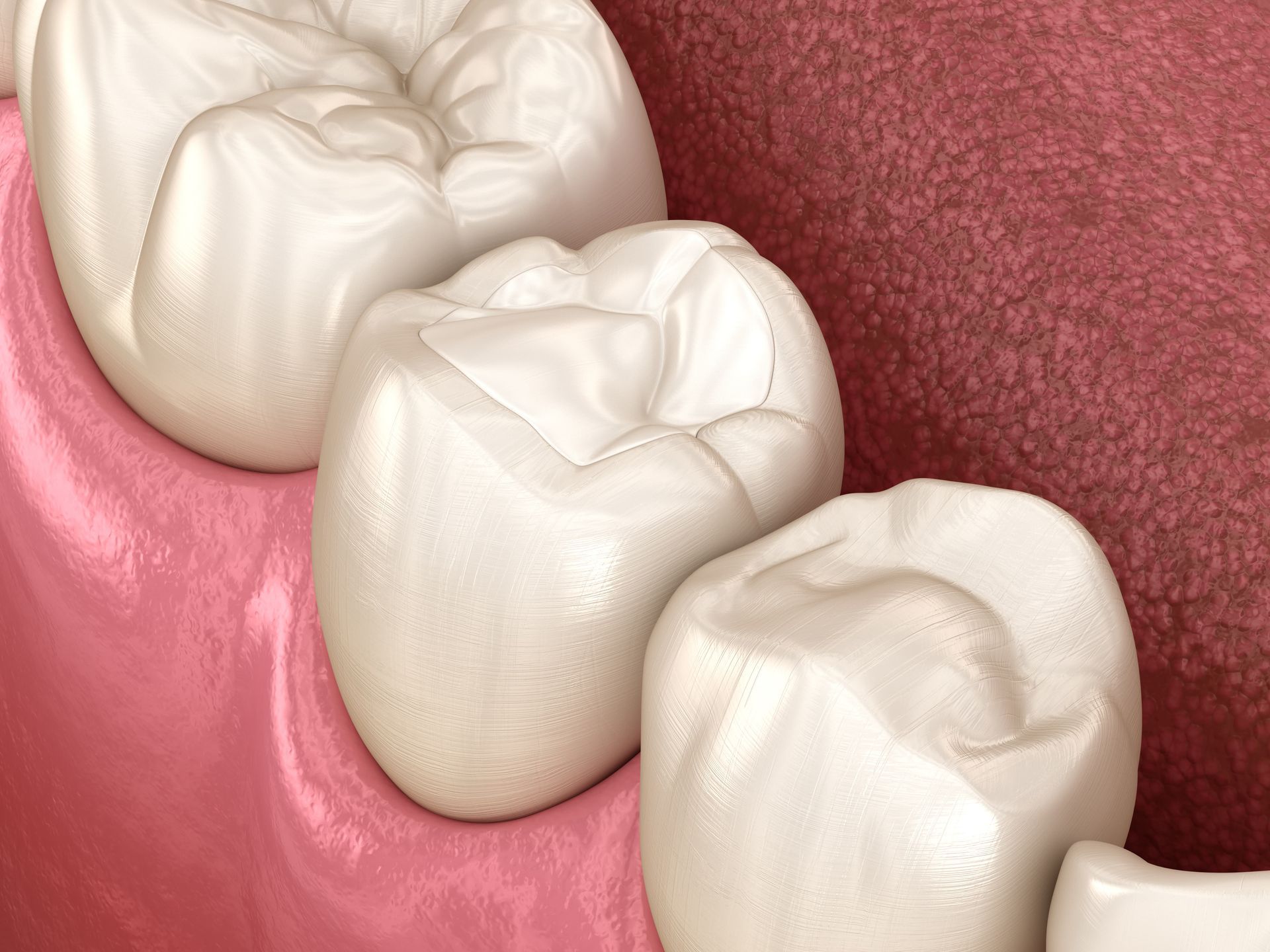 A computer generated image of a white composite filling in a tooth