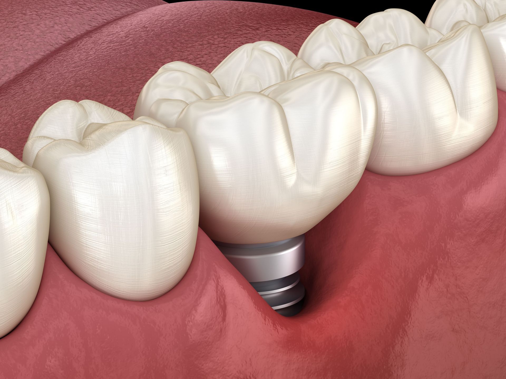 A computer generated image showing a dental implant in the gum