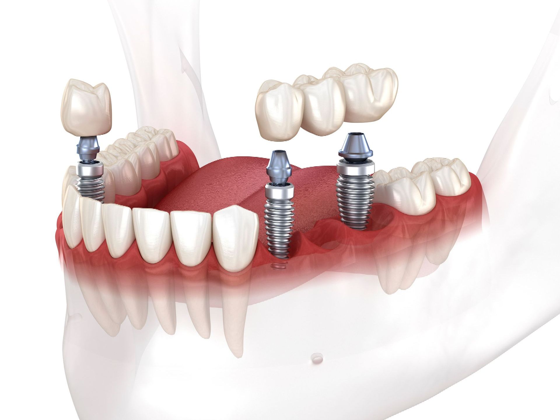 A computer generated image of multiple teeth being replaced with dental implants