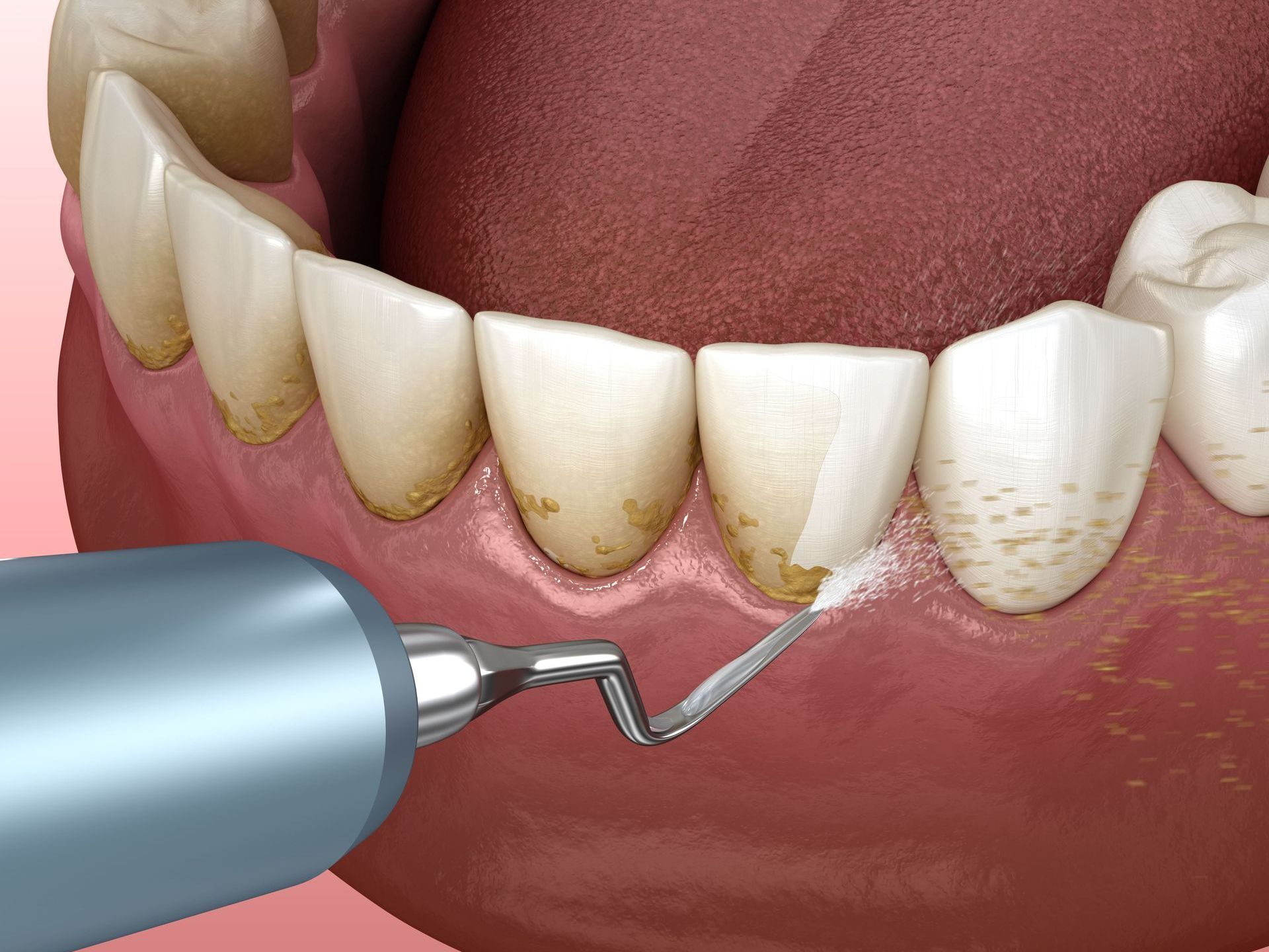 A computer generated image of a periodontal cleaning