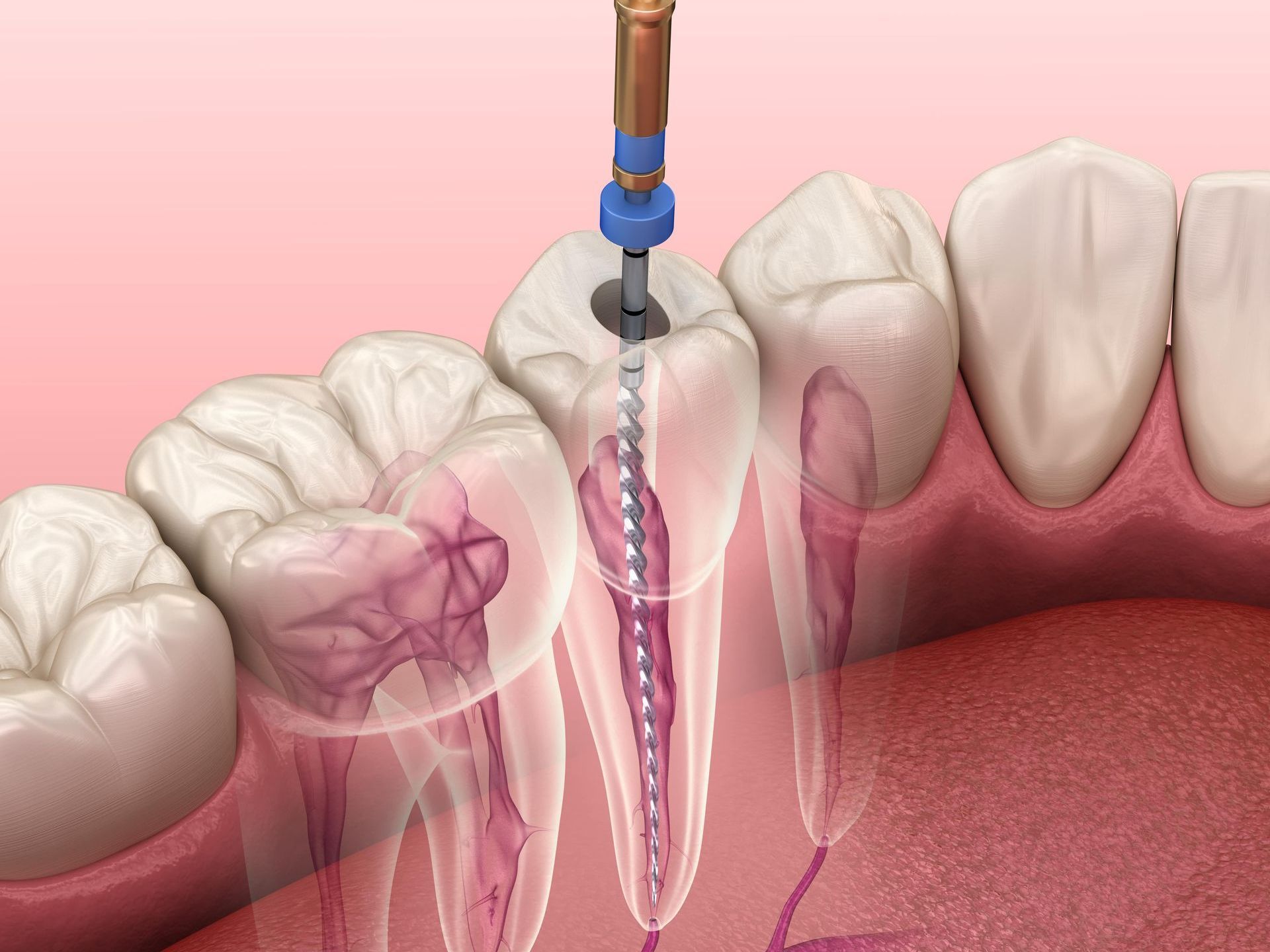 A computer generated image of root canal therapy