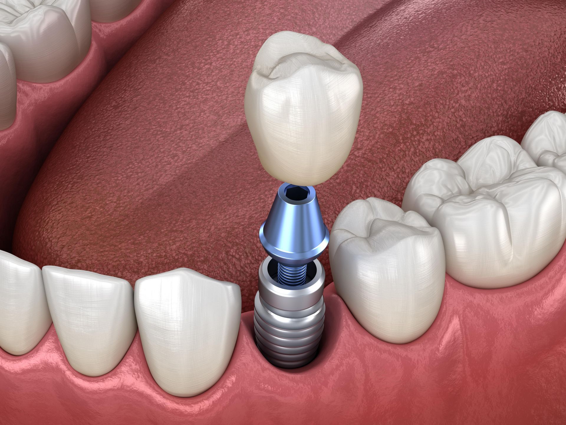 A computer generated image showing a single dental implant, abutment, and crown