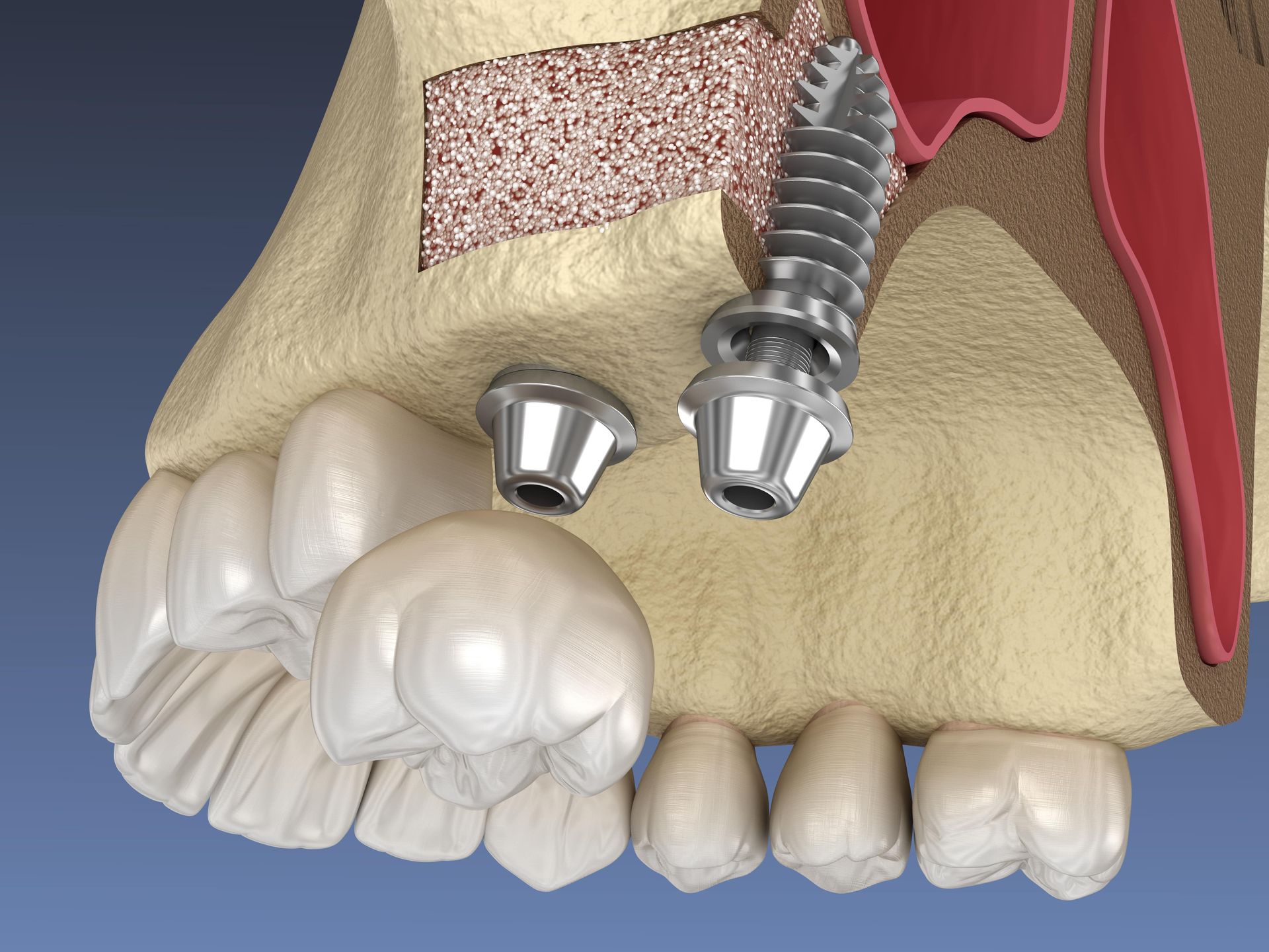 A computer generated image of two dental implants in a filled sinus