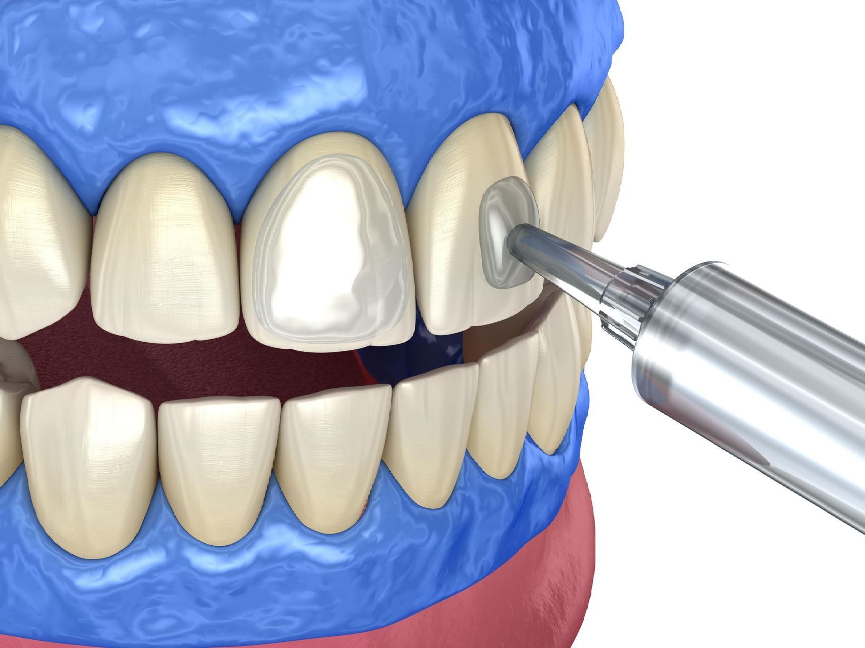 A computer generated image of whitening gel being applied to teeth