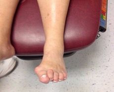 Bunions Warts and Hammer Toes