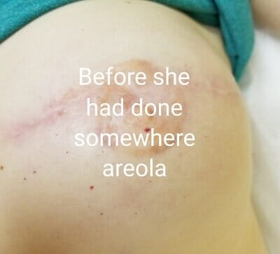 before areola pigmentation - Cosmetic Tattooing in Appleton, WI