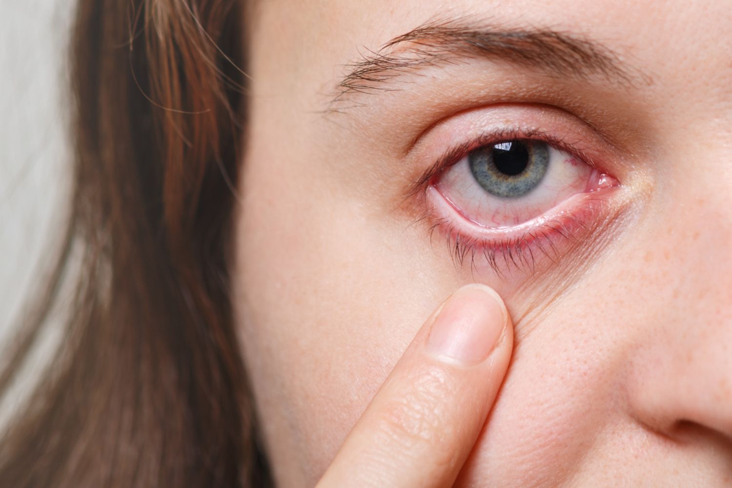 A woman is holding her hand to her red eye.