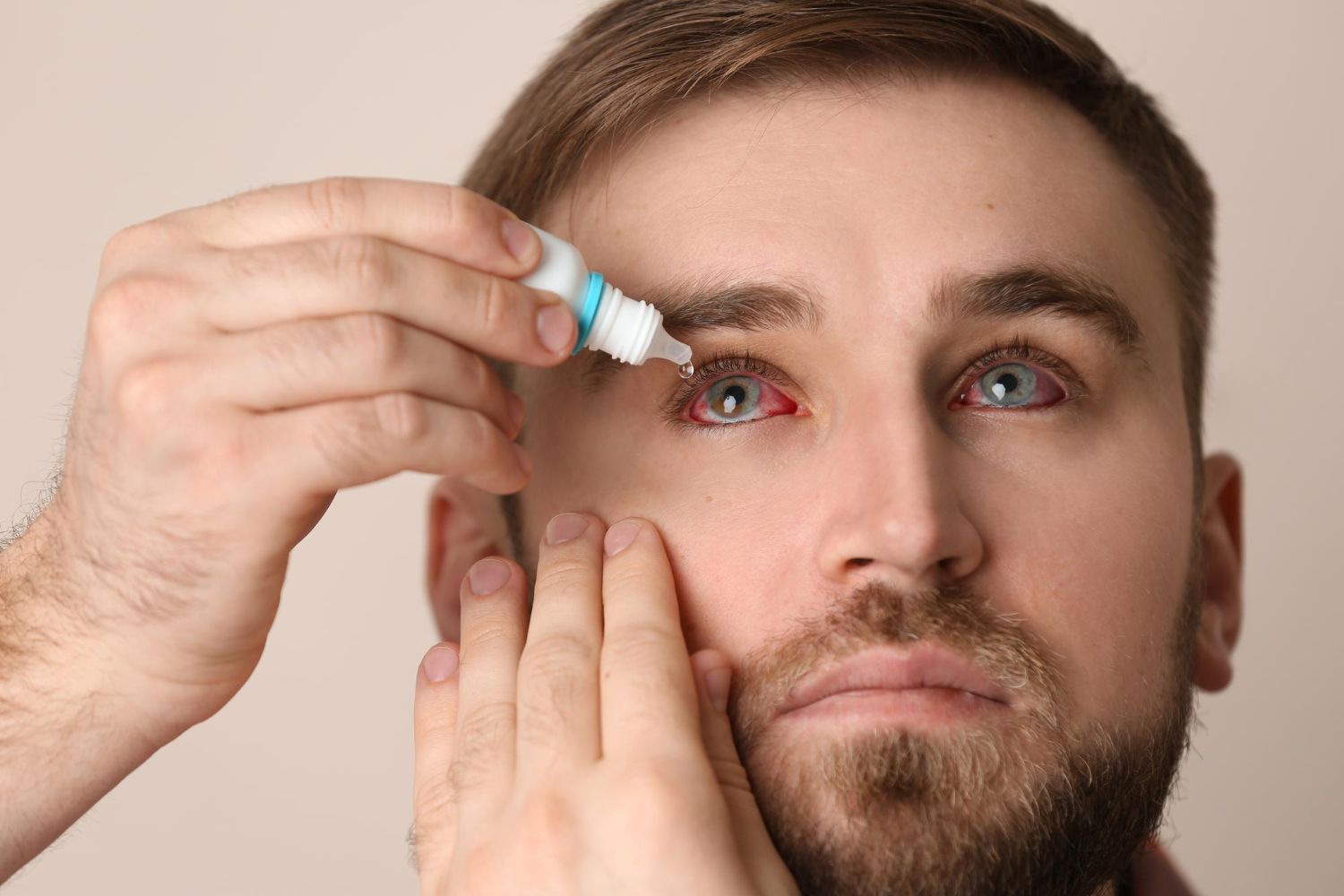 Man applying eye drops to a red eye; light skin, neutral background.