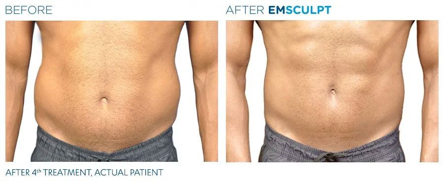 Man before and after EMSCULPT machine treatment