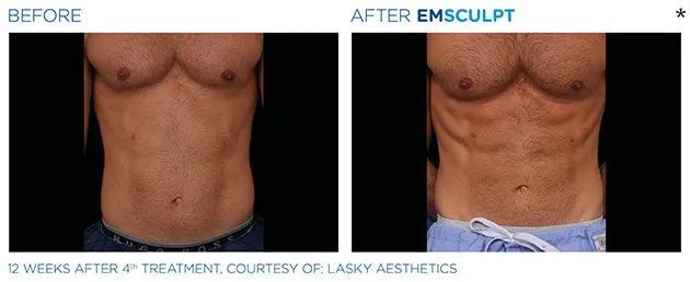 Before and after results of EMSCULPT machine treatment