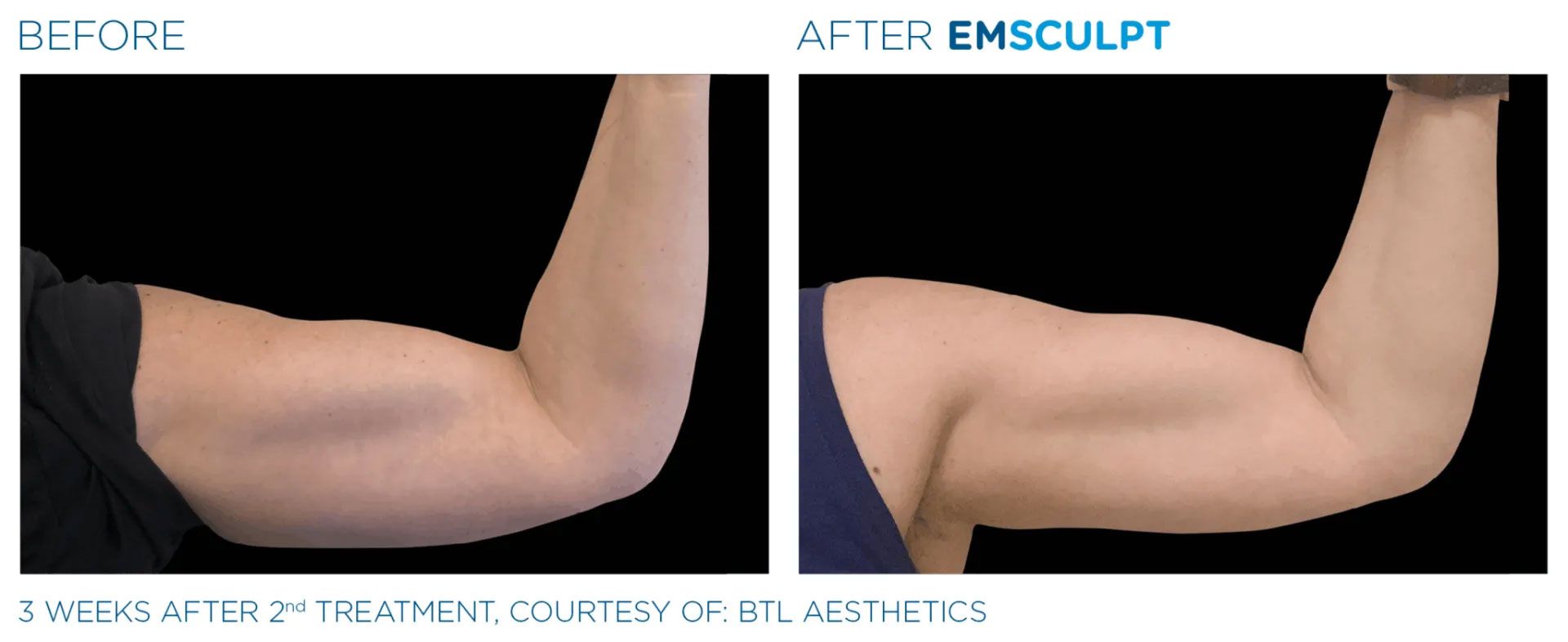 before and after results of EMSCULPT machine treatments on arms