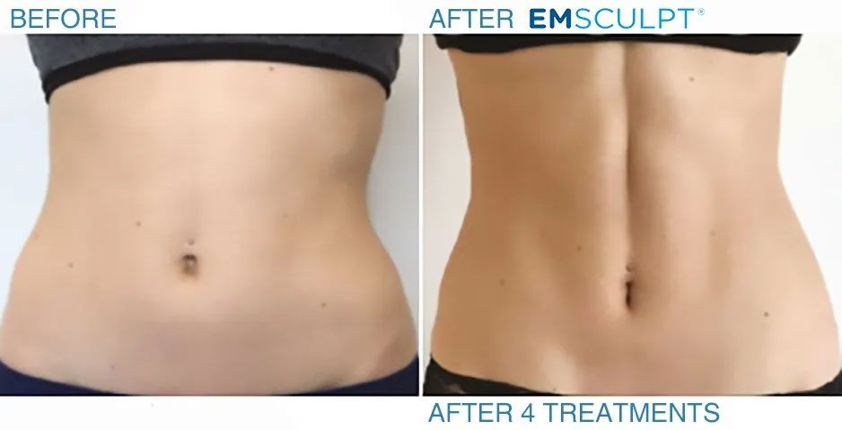 Woman before and after results of 4 EMSCULPT machine treatments