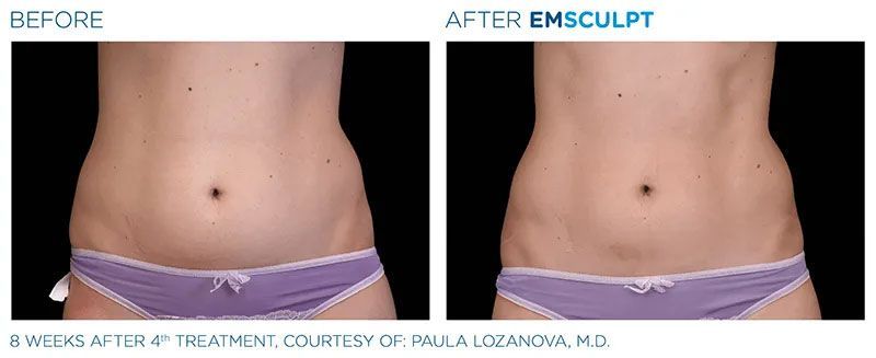 before and after results of EMSCULPT machine treatment on abdominal muscles