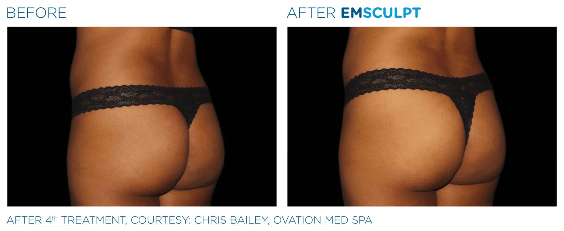 before and after of EMSCULPT machine treatment on butt muscles