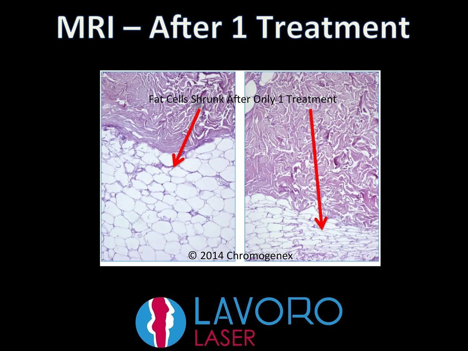 MRI after 1 laser liposuction treatment