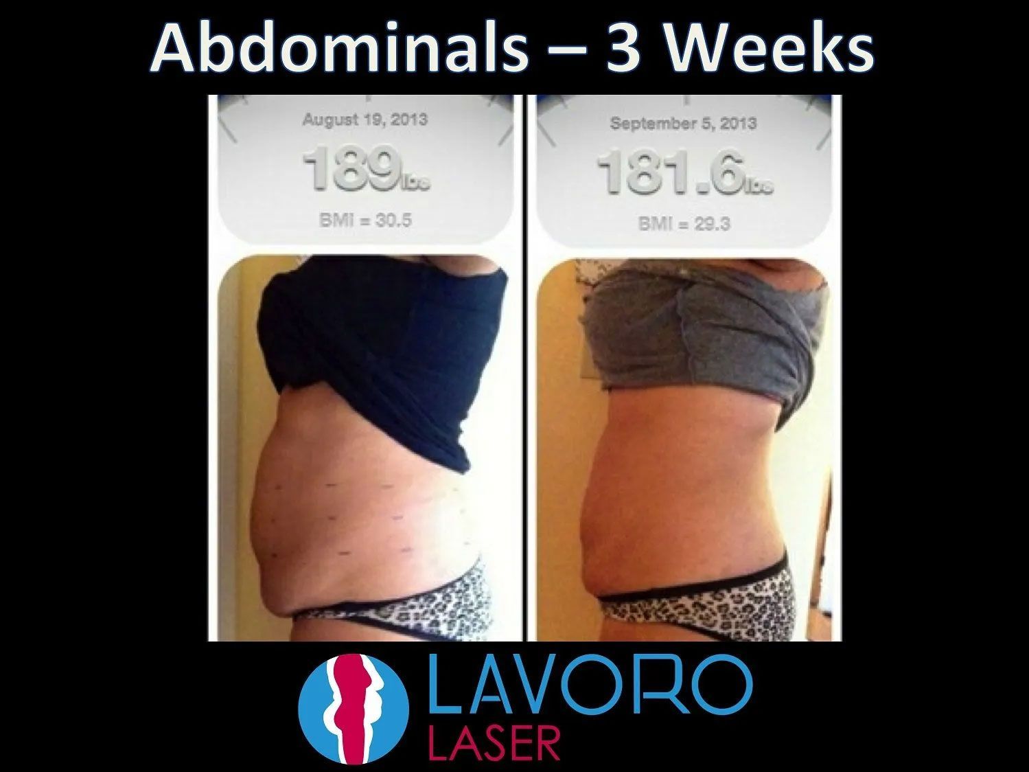 woman's before and after results of abdominal laser fat removal