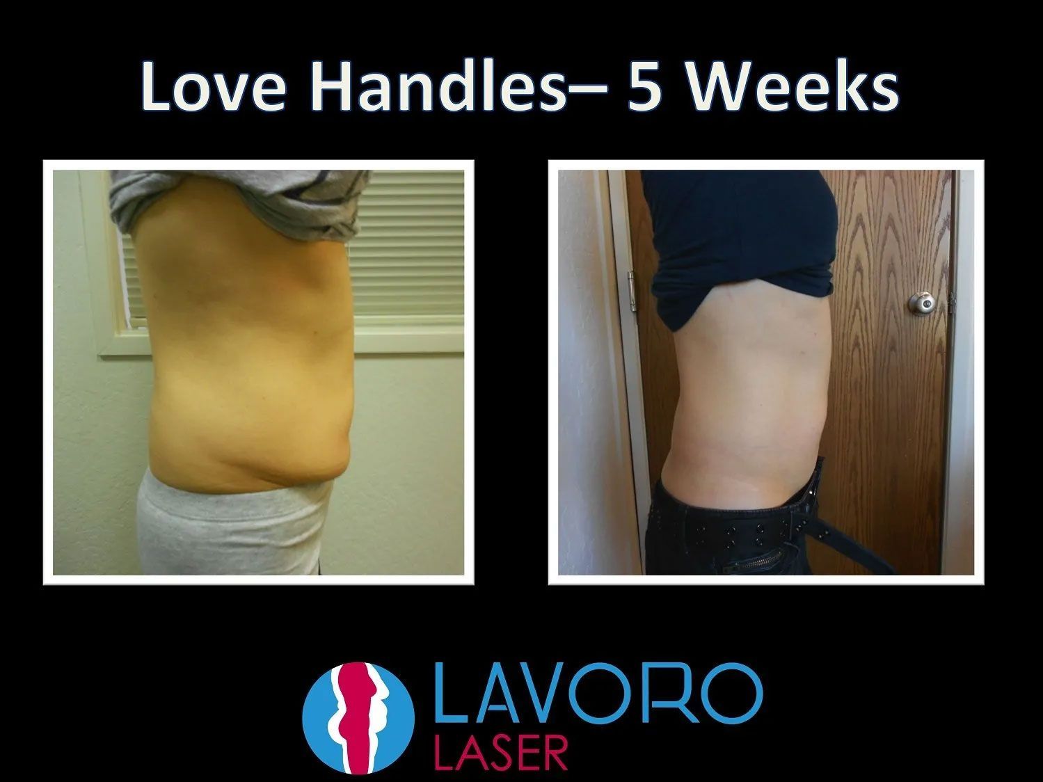 Woman's before and after laser fat removal treatment on love handles
