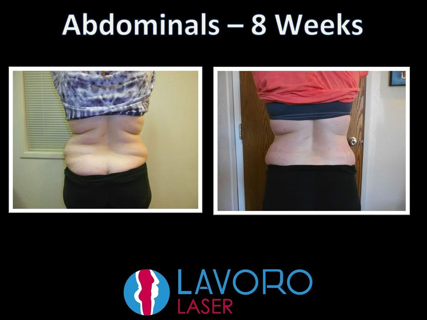 woman's before and after laser fat removal treatment results