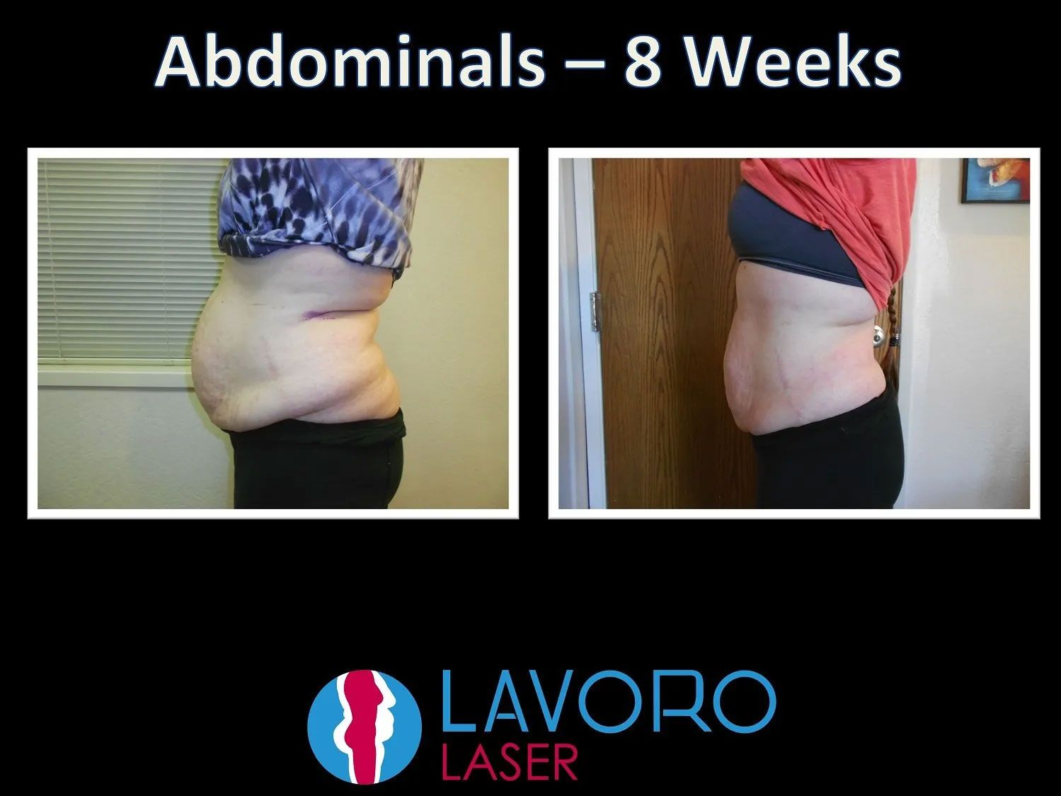 before and after results of laser fat removal treatment