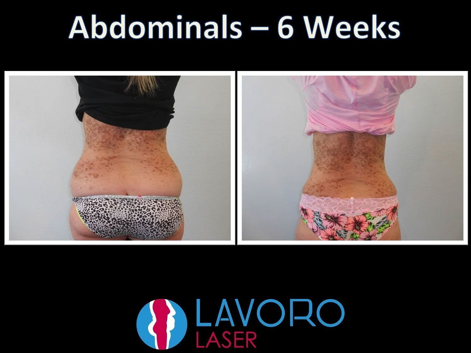 before and after results of laser liposuction procedure