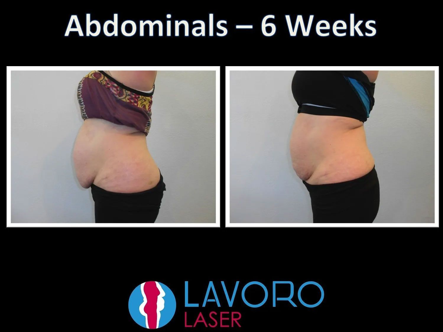 woman's before and after results of skin tightening treatment