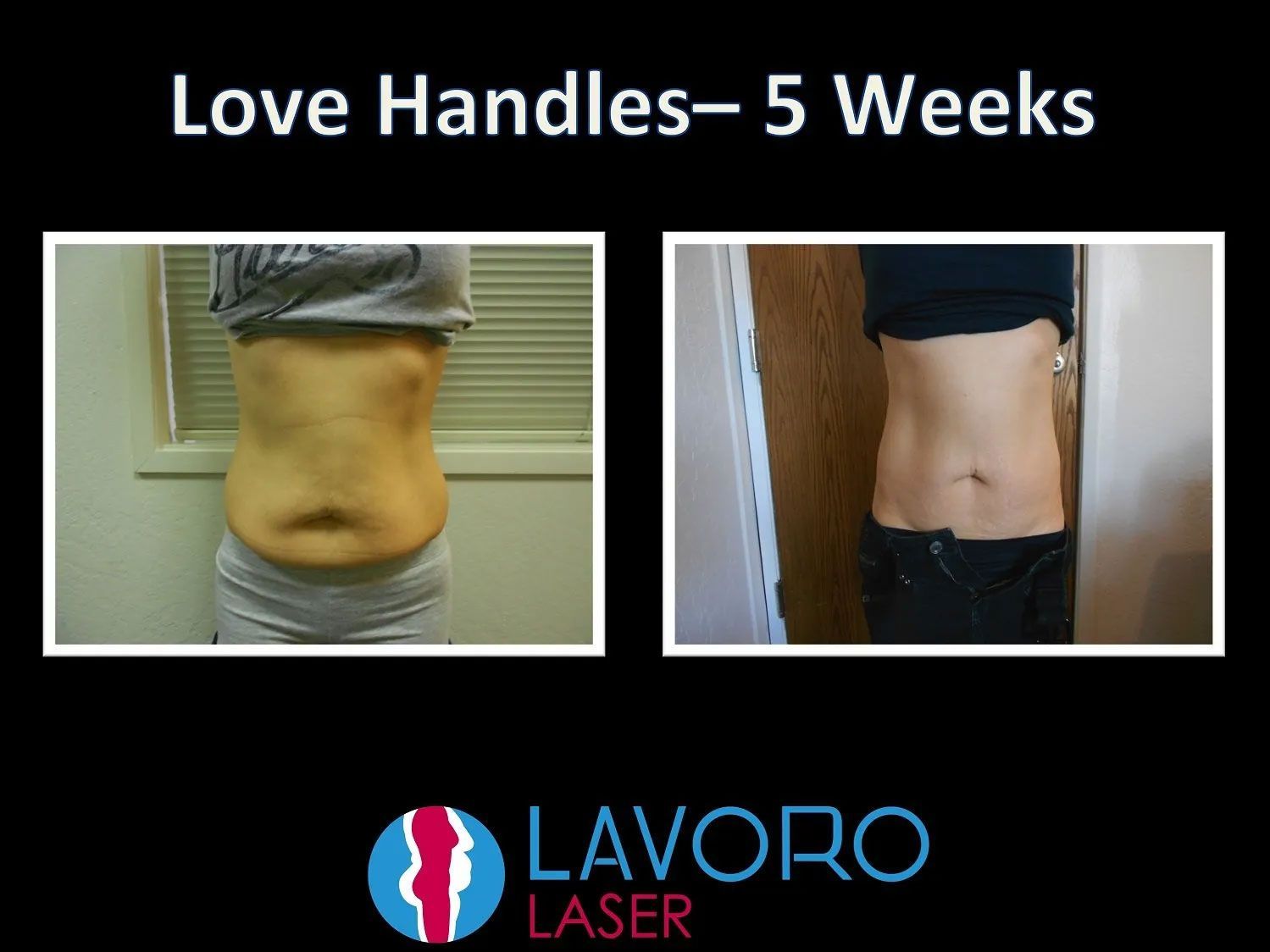 before and after skin tightening treatment results