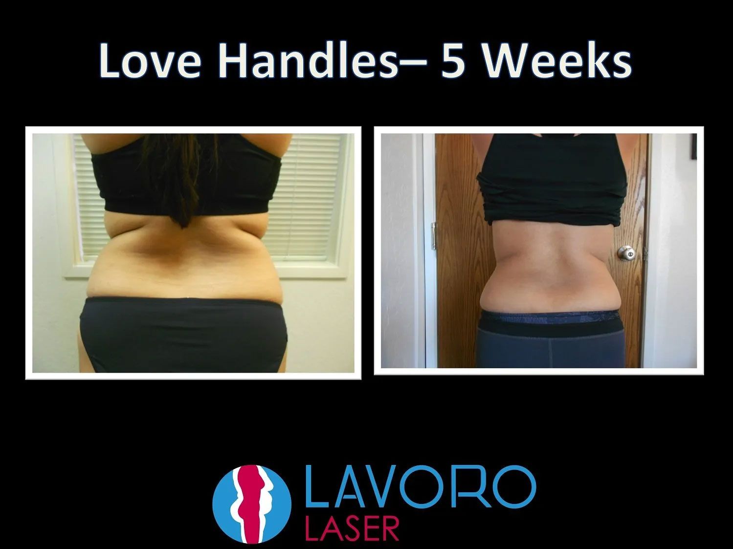 before and after results of laser fat removal procedure