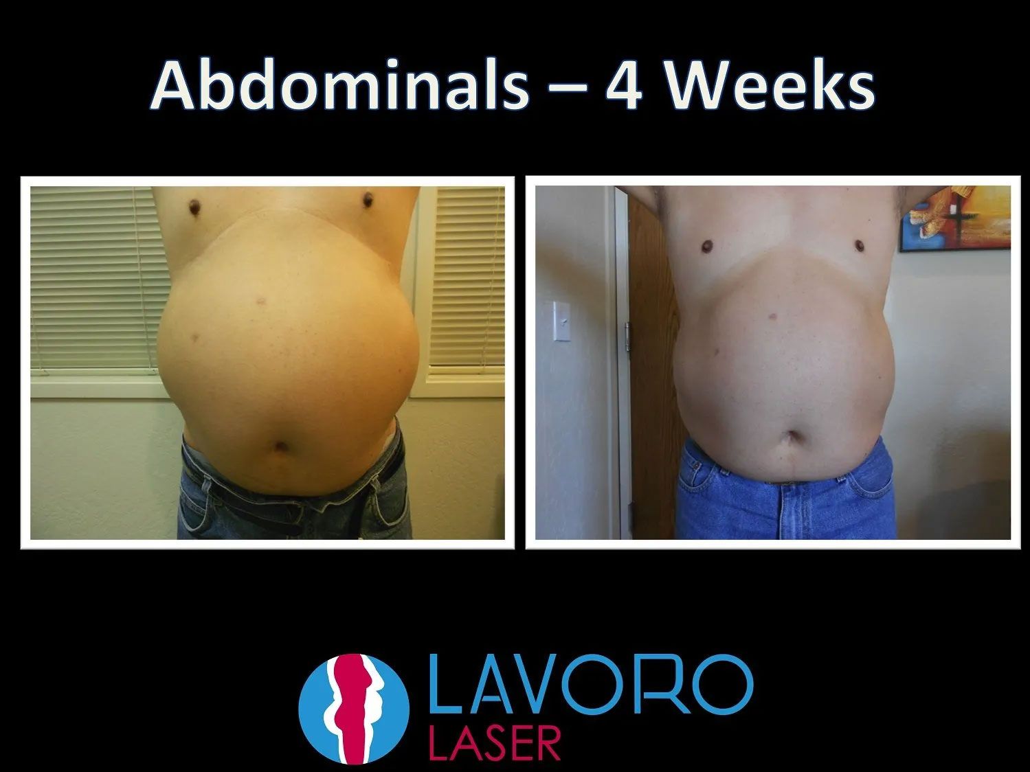 Man's before and after results of laser fat removal treatment