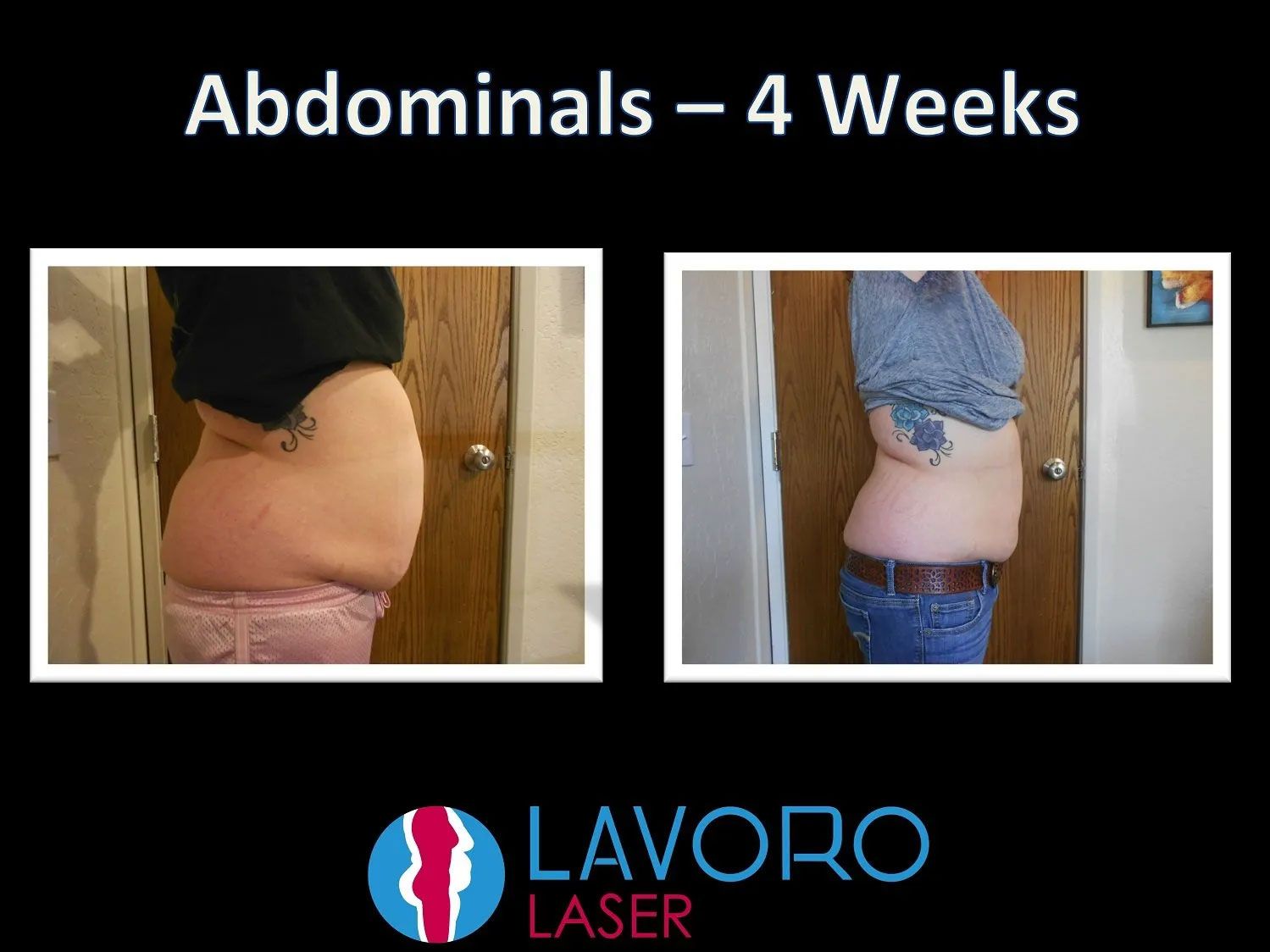 before and after results of skin tightening treatment