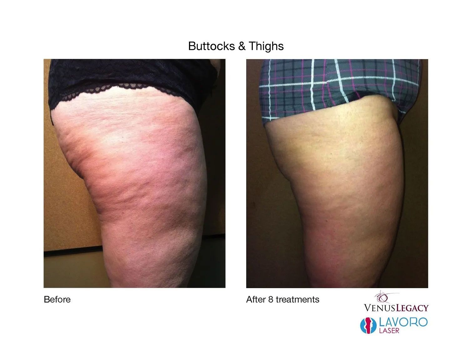 Cellulite Removal Treatments in Walnut Creek CA