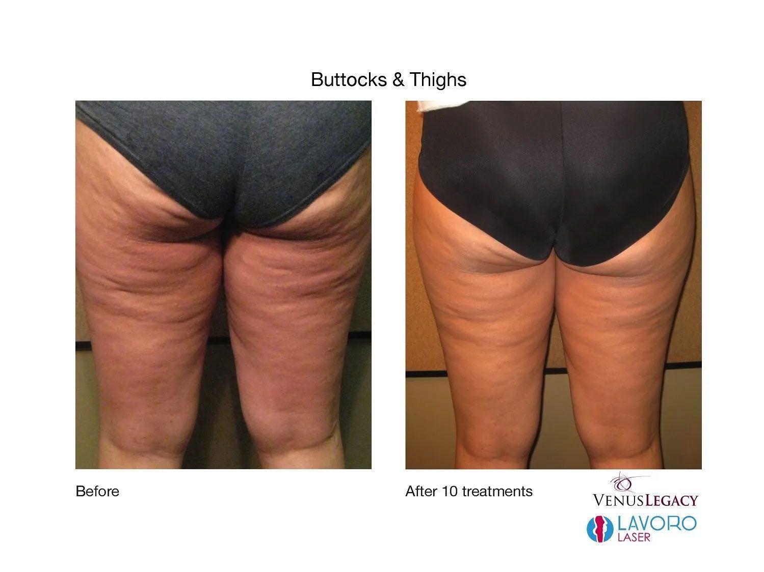 Thigh Cellulite Removal in Walnut Creek CA