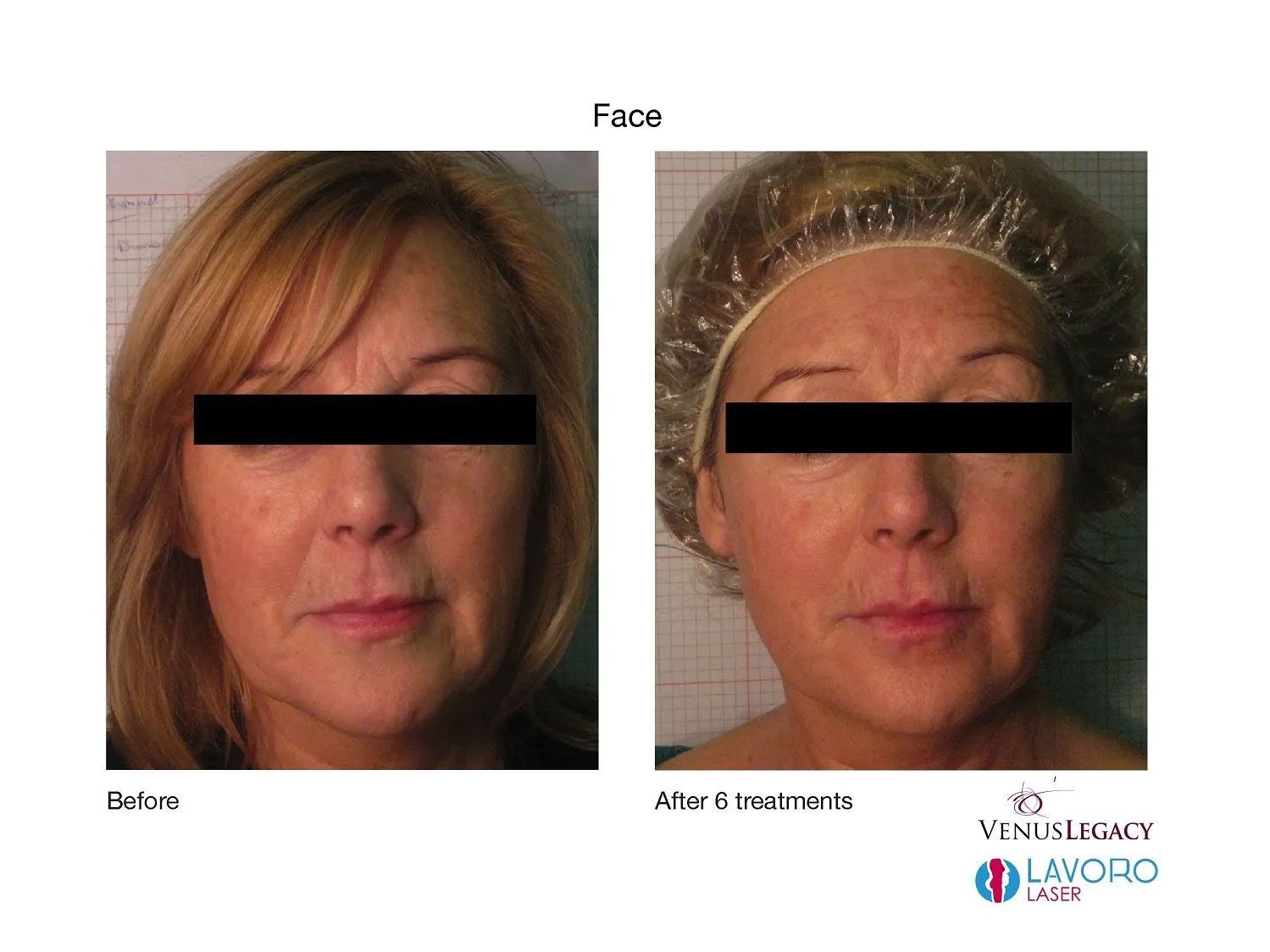 Skin Tightening Treatments in Walnut Creek CA