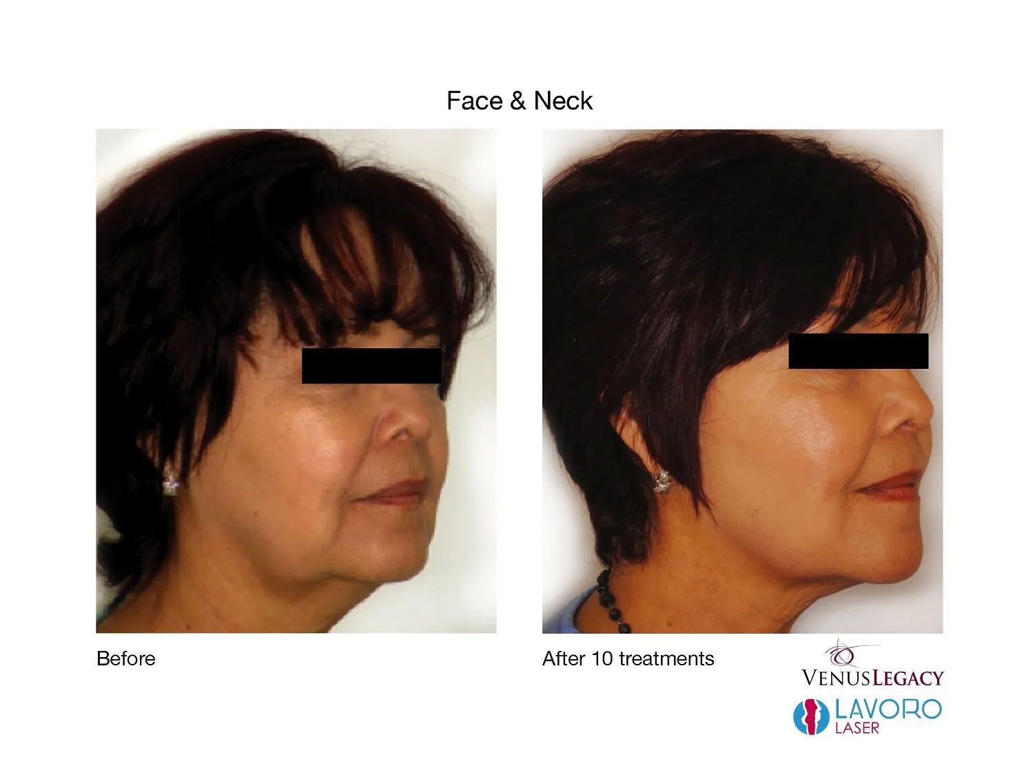 Fat Reduction Treatments in Walnut Creek CA