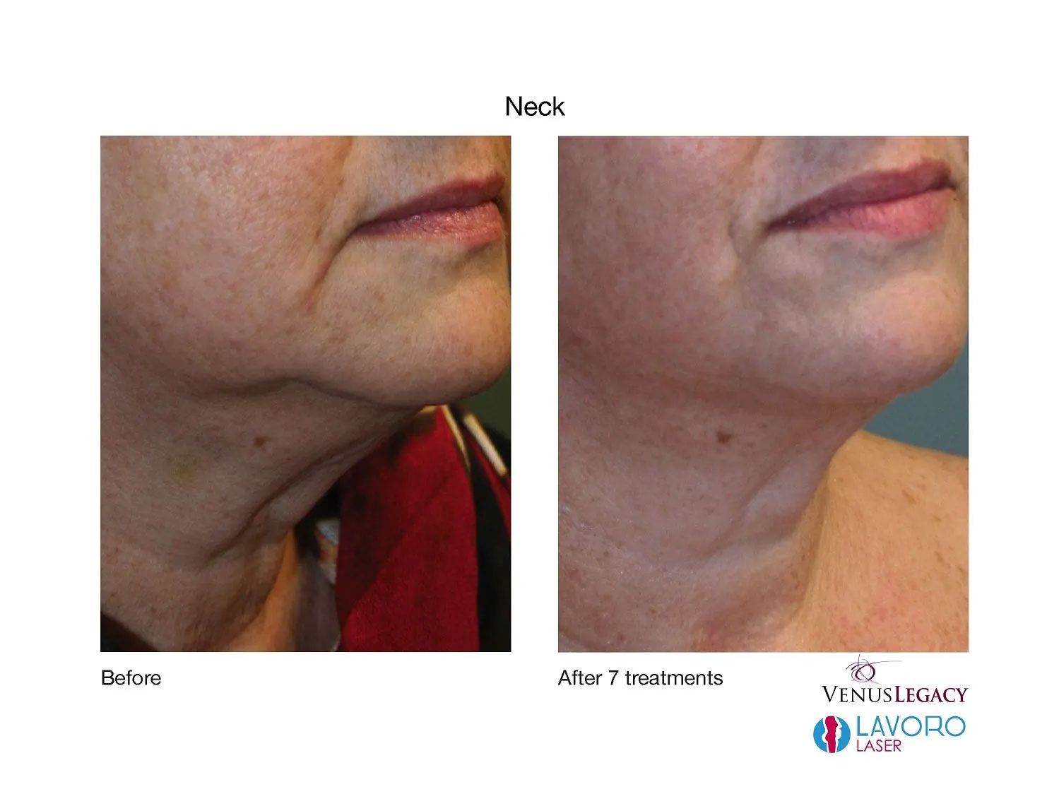 Neck Skin Tightening Treatment in Walnut Creek CA