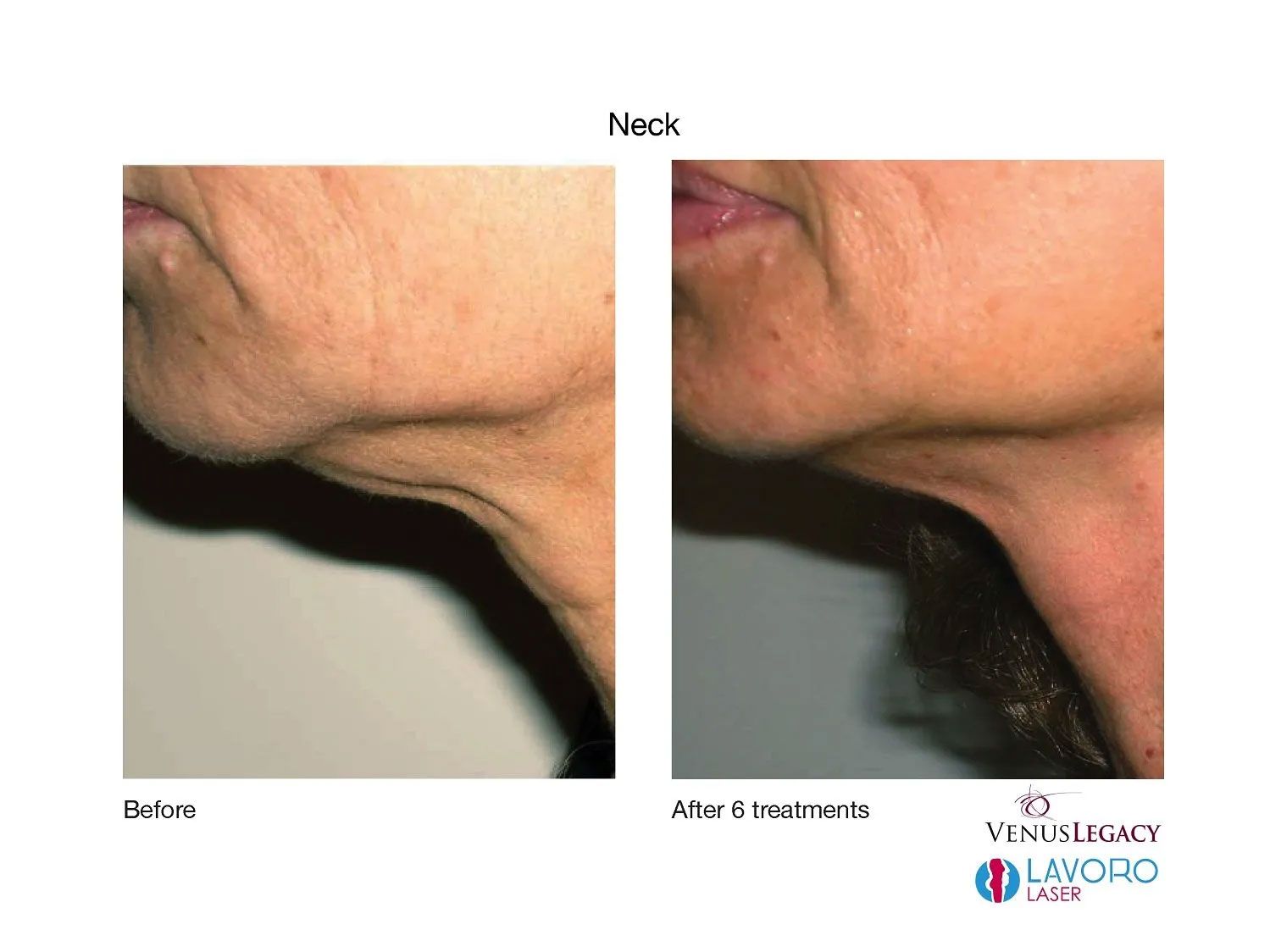 Under the neck skin tightening treatment in Walnut Creek, CA