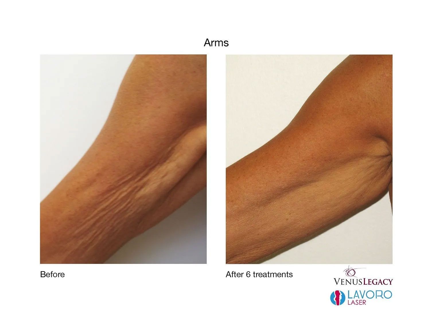 arm skin tightening treatment  in walnut creek ca