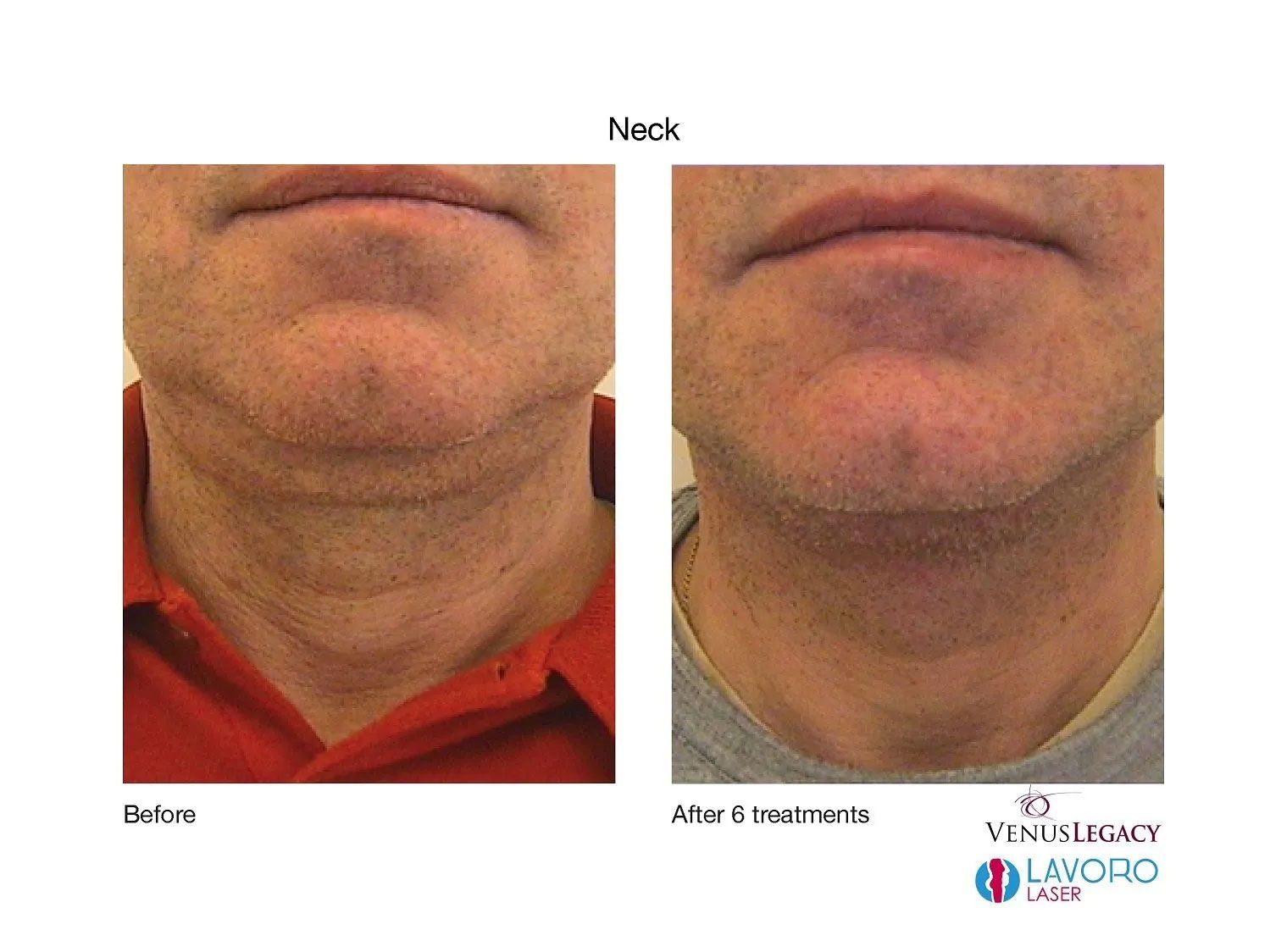 Under the Chin Fat Skin Tightening Treatment in Walnut Creek CA