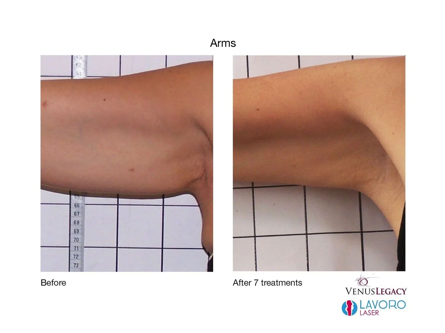 Under Arm Skin Tightening Treatments in Walnut Creek, CA
