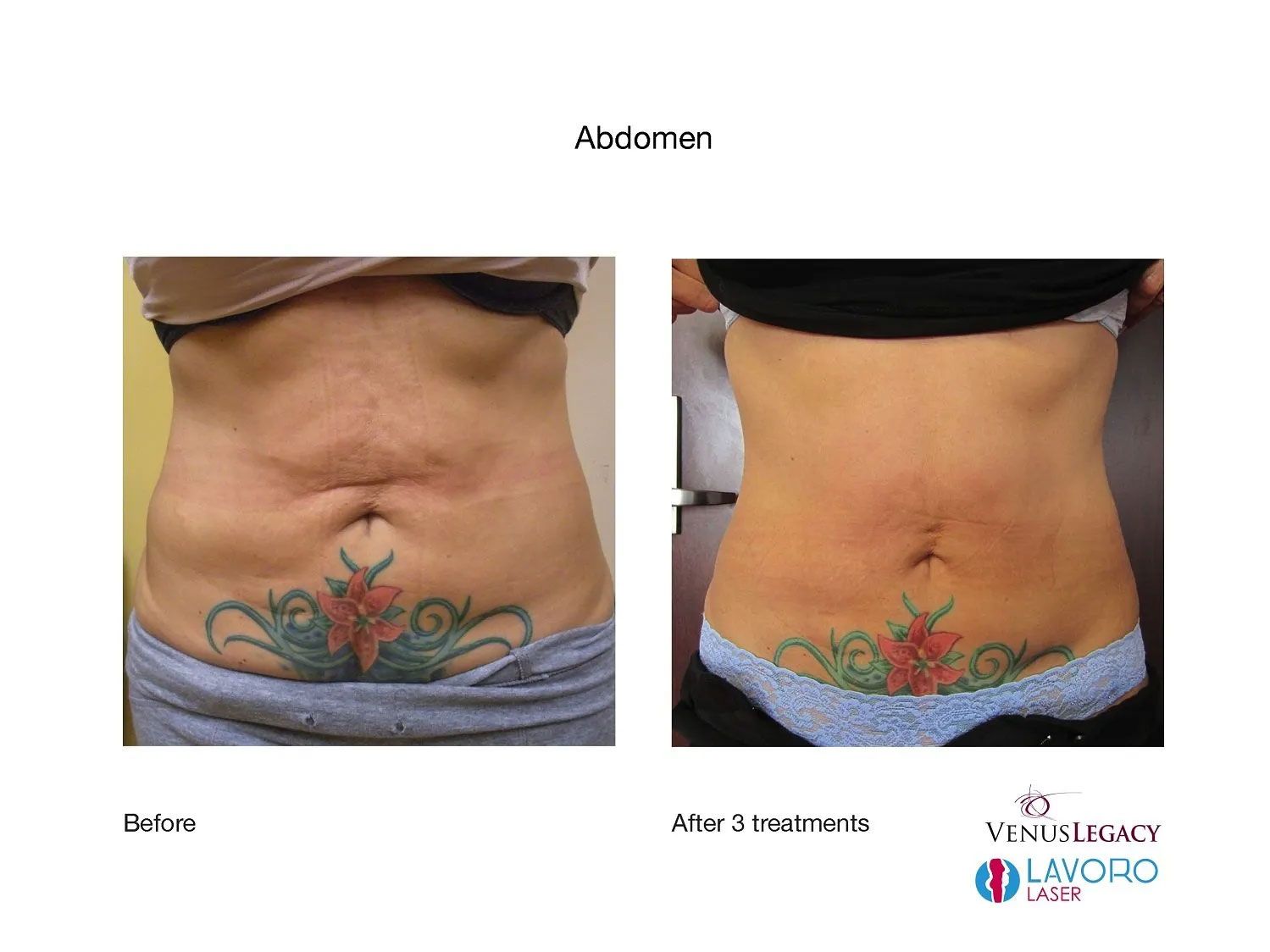 Post Pregnancy Skin Tightening  Treatment in Walnut Creek CA