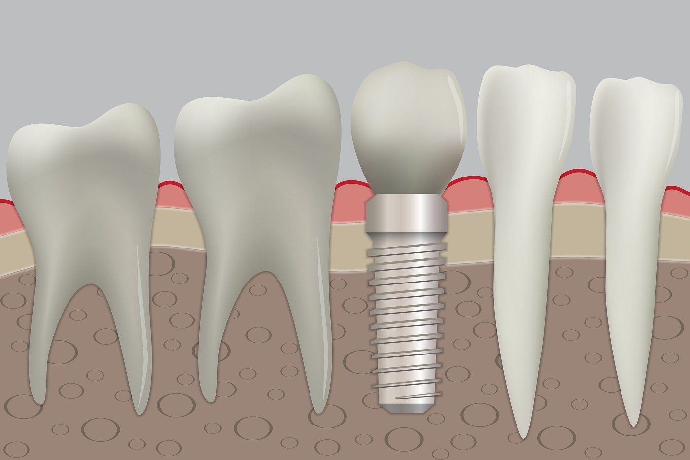 The dental implant process