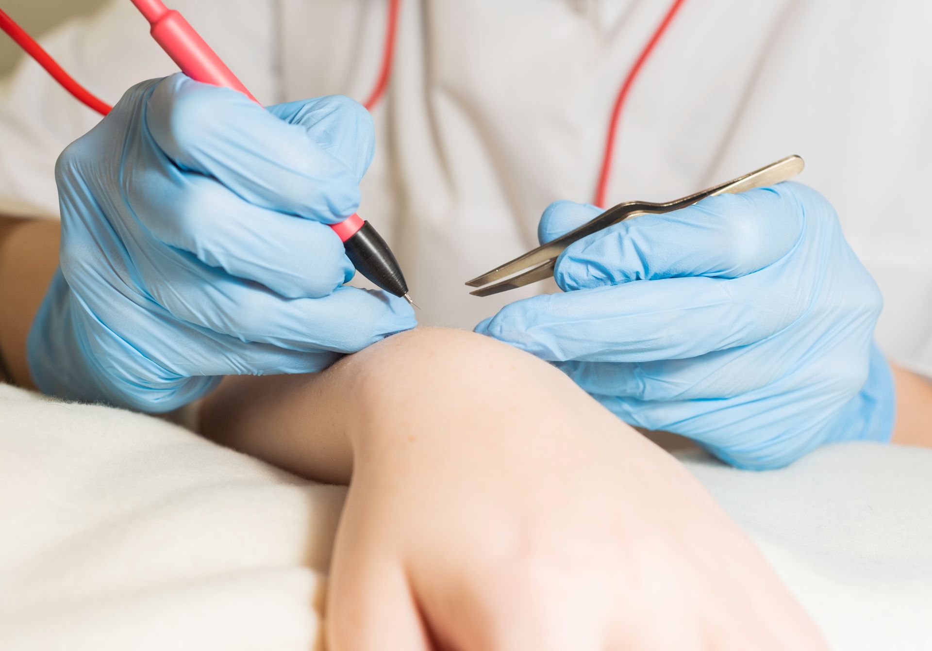 Electrolysis Hair Removal Near Me Permanent Solution for Unwanted Body Hair