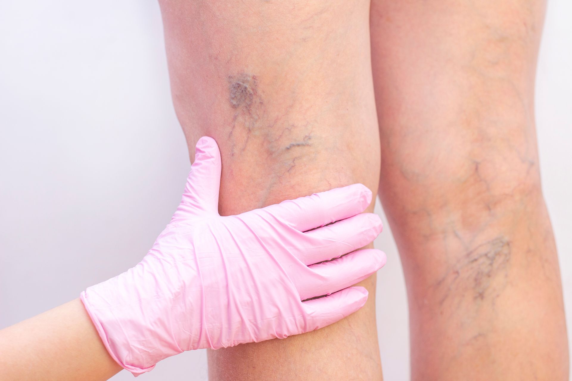 A person's legs with visible varicose veins; a gloved hand touches the leg.