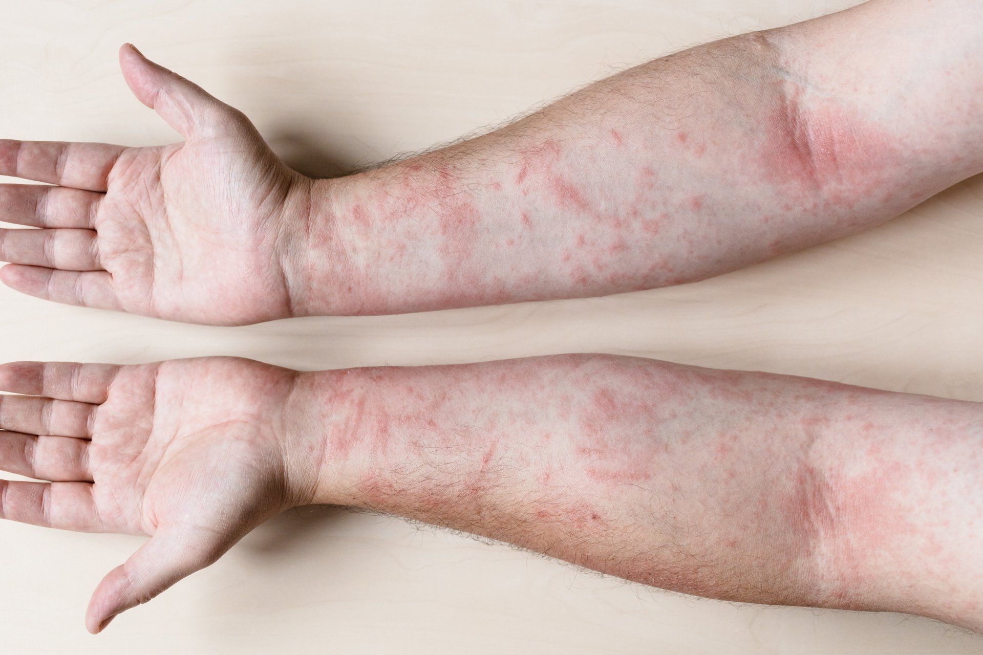 A close up of a person 's arms with red spots on them.