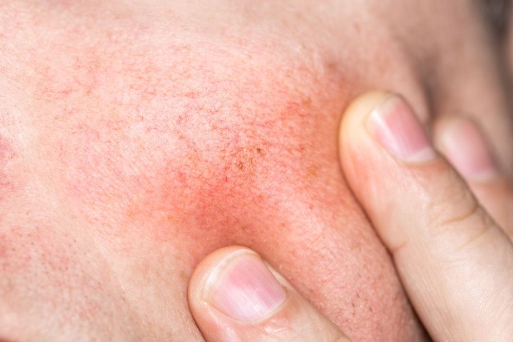 Close-up of a person's fingers pressing into an area of red, irritated skin on the cheek.