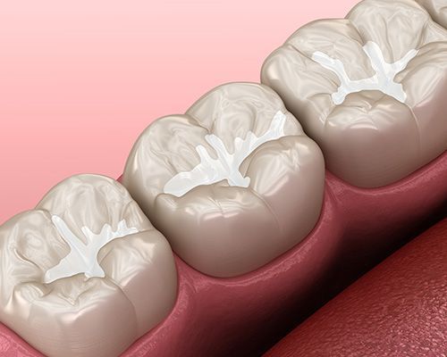 Dental Sealants
