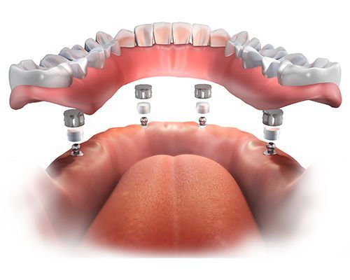 Dental Implants