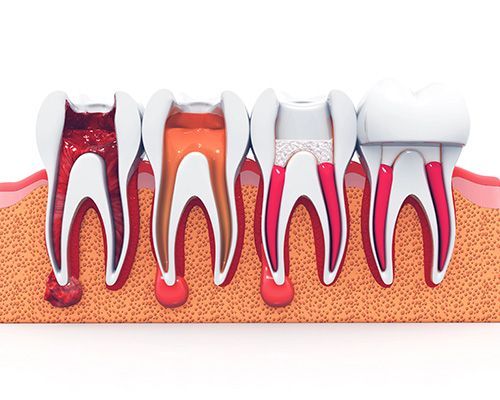 Root Canal Treatment
