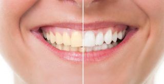 A close up of a woman 's teeth before and after whitening.